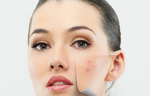 tinh dầu thông đỏ trị mụn