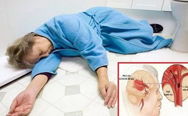 thuốc chống đột quỵ Hàn Quốc sẽ có tác dụng tốt nhất nếu bạn sử dụng ngay khi được dựa đoán là có nguy cơ mắc tai biến mạch máu não